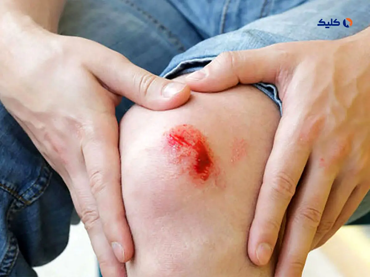 درمان زخم ها با الکتریسیته