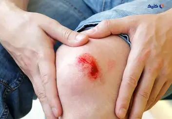 درمان زخم ها با الکتریسیته