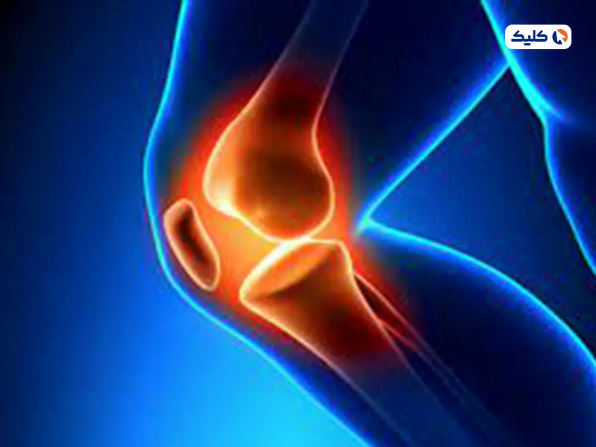 روش جدید درمان آرتروز توسط دانشمندان ابداع شد