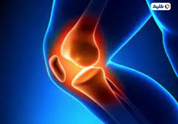 روش جدید درمان آرتروز توسط دانشمندان ابداع شد