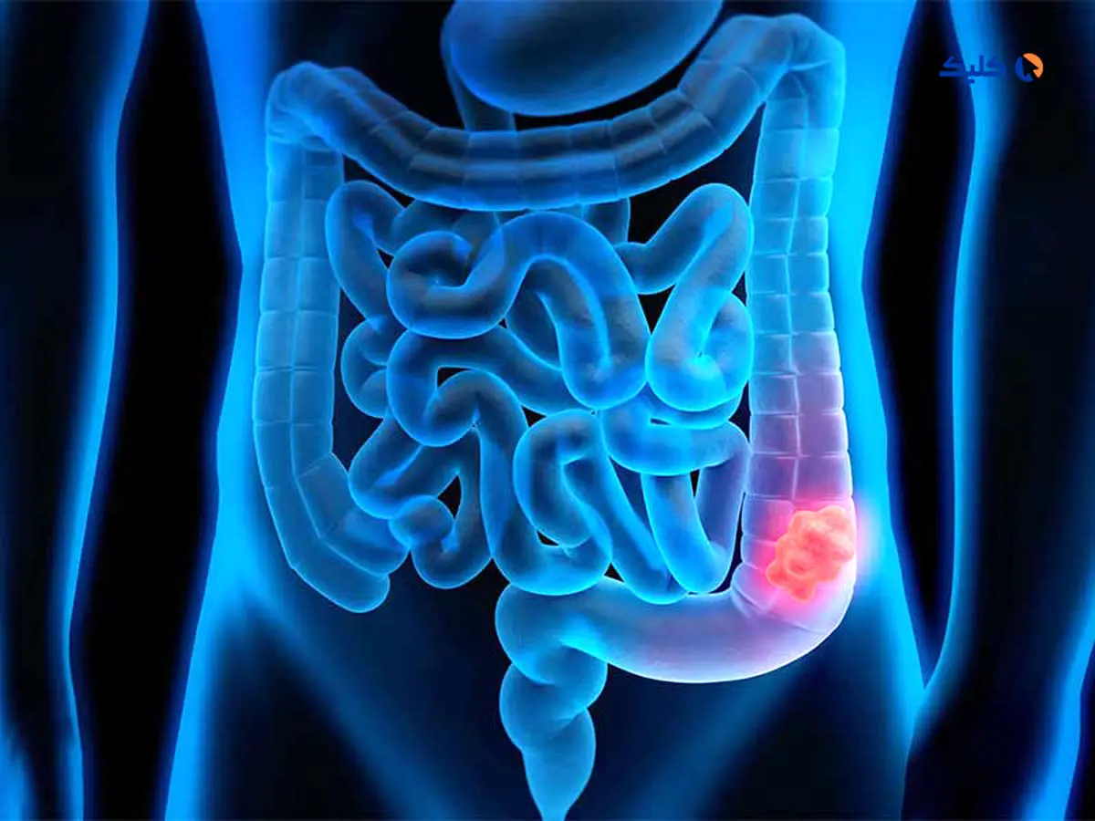 ۴ علامت سرطان روده که ۲ سال زودتر از تشخیص ظاهر می‌شوند