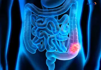 ۴ علامت سرطان روده که ۲ سال زودتر از تشخیص ظاهر می‌شوند