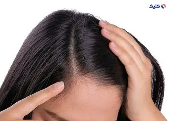 کمبود پتاسیم یکی از دلایل عمده ریزش مو