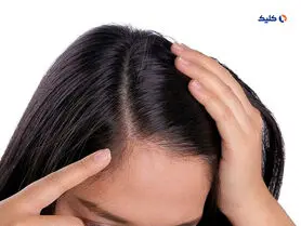 کمبود پتاسیم یکی از دلایل عمده ریزش مو