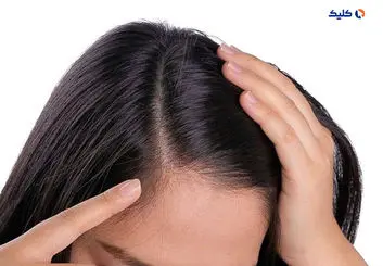 کمبود پتاسیم یکی از دلایل عمده ریزش مو