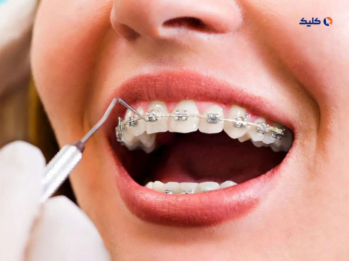 تولید سیم‌های ارتودنسی با سیم‌های حافظه‌دار در کشور