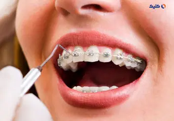 تولید سیم‌های ارتودنسی با سیم‌های حافظه‌دار در کشور