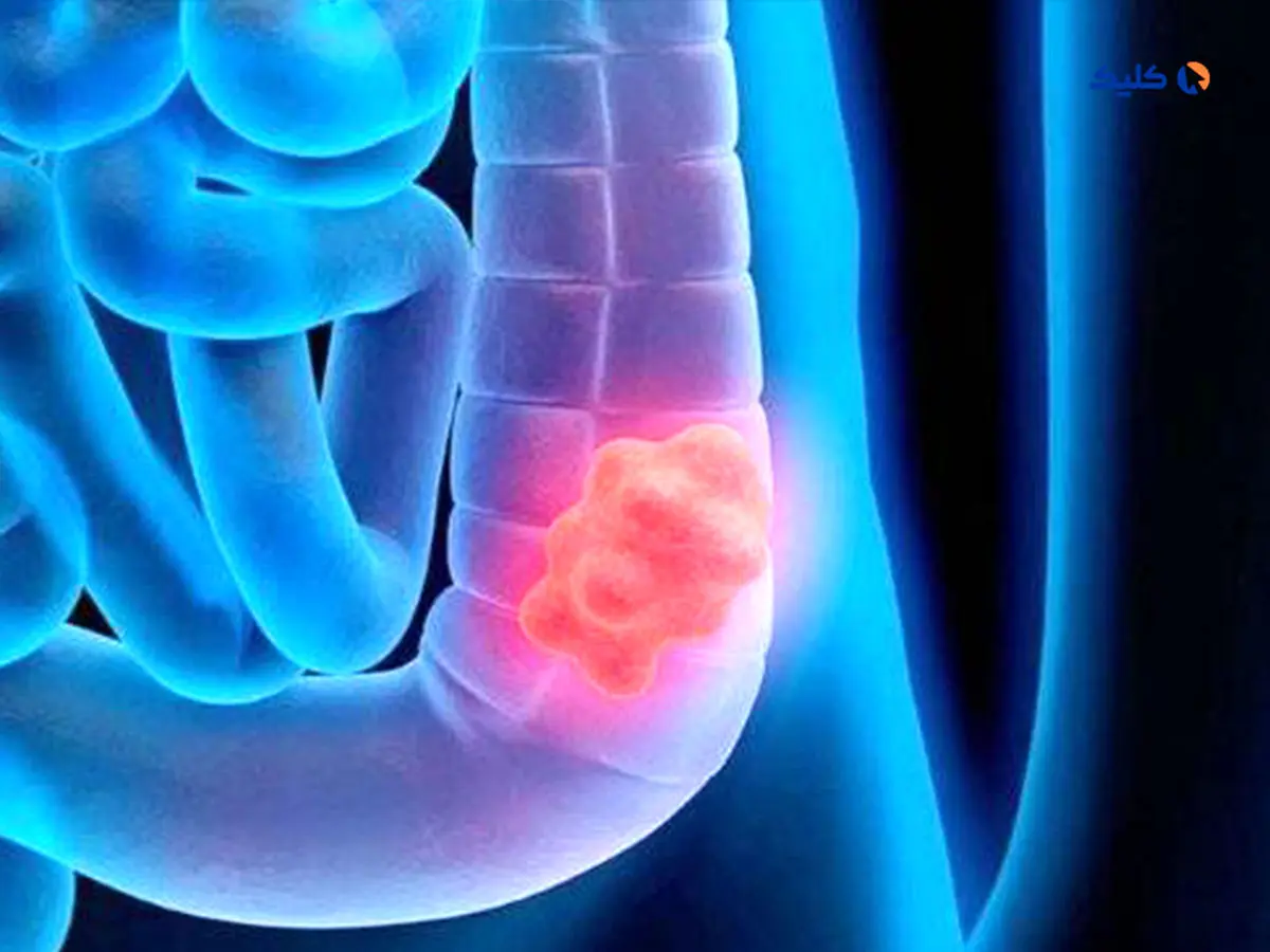 آواتارهای توموری؛ رویکردی جدید برای درمان شخصی سرطان