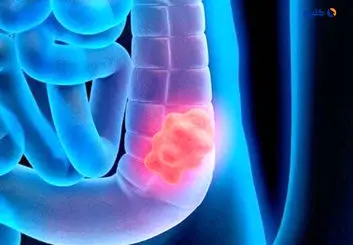 آواتارهای توموری؛ رویکردی جدید برای درمان شخصی سرطان