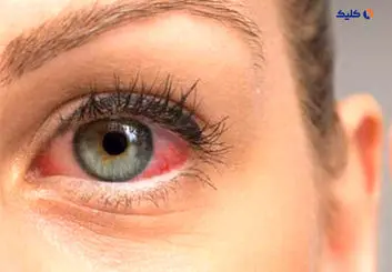 پروبیوتیک خوراکی نویدبخش درمان بیماری خشکی چشم