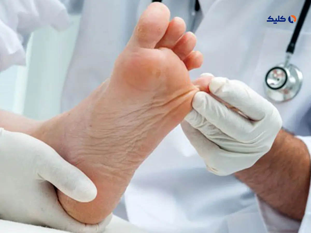 بهبود زخم های دیابت با طراحی و ساخت زخم پوش های پودری