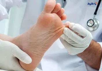 بهبود زخم های دیابت با طراحی و ساخت زخم پوش های پودری