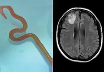 پیداشدن «کرم زنده» در مغز یک زن استرالیایی