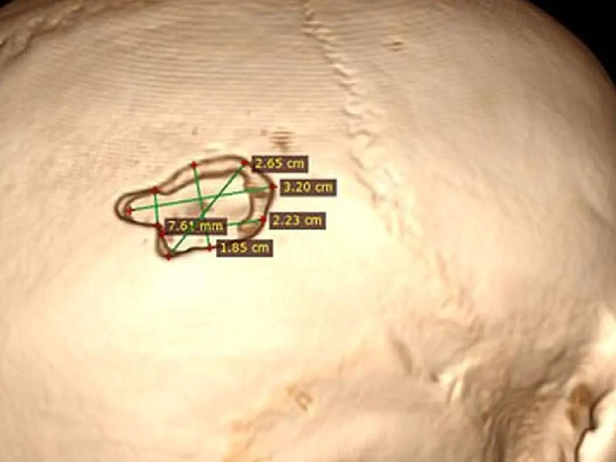 کنترل رؤیا با ایمپلنت مغزی؛ یک محقق روسی با دریل جمجمه‌اش را سوراخ کرد و در مغزش تراشه کاشت!