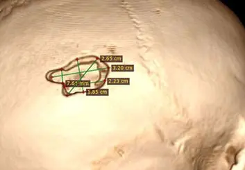 کنترل رؤیا با ایمپلنت مغزی؛ یک محقق روسی با دریل جمجمه‌اش را سوراخ کرد و در مغزش تراشه کاشت!