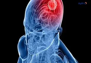 توسعه ابزار کوچکی که می‌تواند هم‌زمان بیش از ۲۰ درمان را برای سرطان مغز تست کند