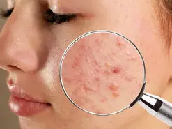 به کمک یک داروی خاص فناوری نانو به جنگ آکنه می رود