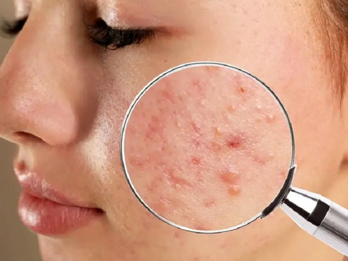 به کمک یک داروی خاص فناوری نانو به جنگ آکنه می رود