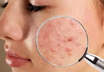 به کمک یک داروی خاص فناوری نانو به جنگ آکنه می رود