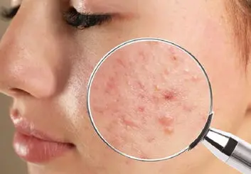به کمک یک داروی خاص فناوری نانو به جنگ آکنه می رود
