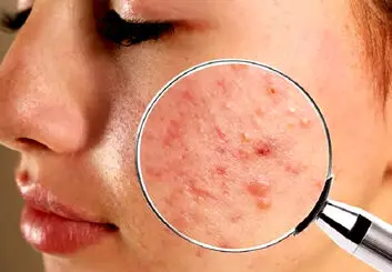 به کمک یک داروی خاص فناوری نانو به جنگ آکنه می رود