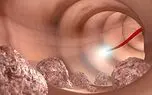 فناوری جدید برای پیشگیری از سرطان کولون