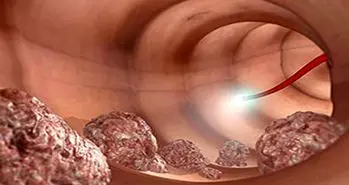 فناوری جدید برای پیشگیری از سرطان کولون