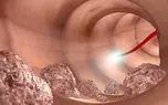 فناوری جدید برای پیشگیری از سرطان کولون
