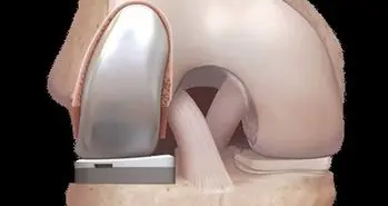 عرضه فناوری جدید در جراحی جایگزینی زانو