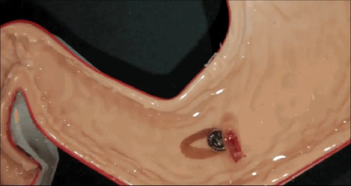 جراحی داخلی معده انسان به کمک یک ربات کوچک