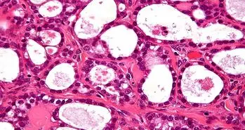 چاپ سه بعدی تومور برای یافتن راه حل این بیماری