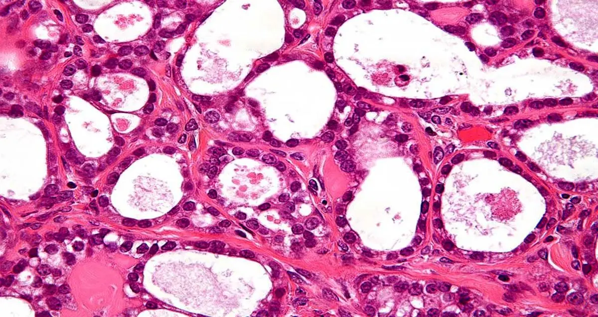 چاپ سه بعدی تومور برای یافتن راه حل این بیماری