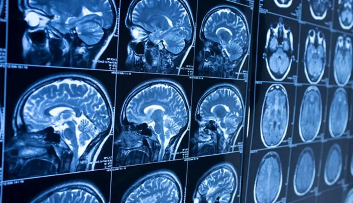 امید به درمان آلزایمر با مدل‌سازی جدید از نورون انسان