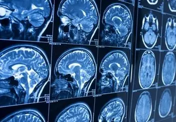 امید به درمان آلزایمر با مدل‌سازی جدید از نورون انسان