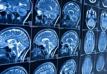 امید به درمان آلزایمر با مدل‌سازی جدید از نورون انسان