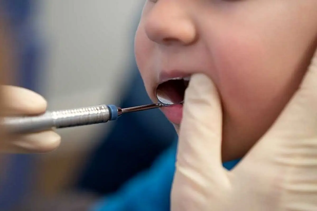 آیا با عصب کشی دندان شیری  عصب دندان دائمی جایگزین آسیب می بیند؟