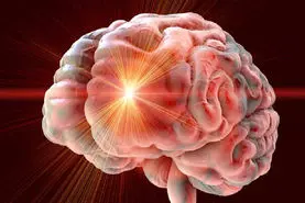 بهبود تحرک و تعادل ۱۲ سال پس از سکته مغزی با تحریک مغناطیسی
