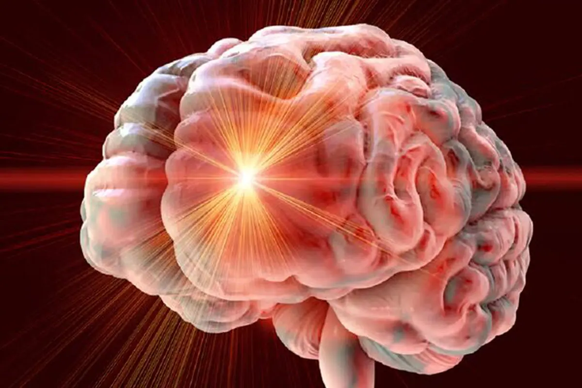 بهبود تحرک و تعادل ۱۲ سال پس از سکته مغزی با تحریک مغناطیسی
