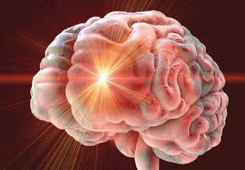 بهبود تحرک و تعادل ۱۲ سال پس از سکته مغزی با تحریک مغناطیسی
