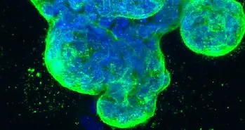 اسید و نور؛ قاتل جدید سلول های سرطانی