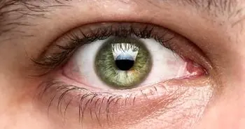 گام بلند پزشکان به سوی درمان نابینایی