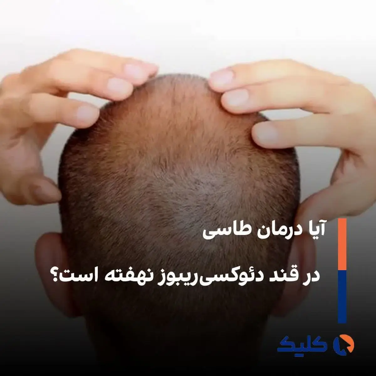 آیا درمان طاسی در قند دئوکسی‌ریبوز نهفته است؟