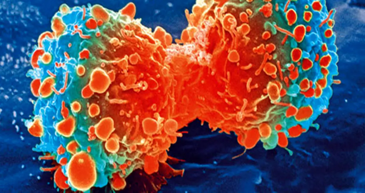 شایع ترین سرطان در ایران کدام است؟