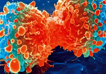 شایع ترین سرطان در ایران کدام است؟