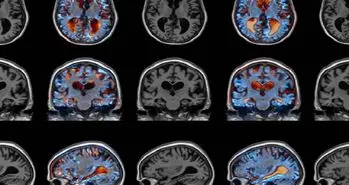 موفقیت بزرگ در درمان آلزایمر و پارکینسون